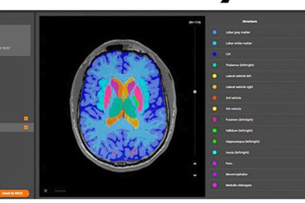 Yapay Zeka MR ile Birleşince Hastalık Teşhisleri Kolayaştı