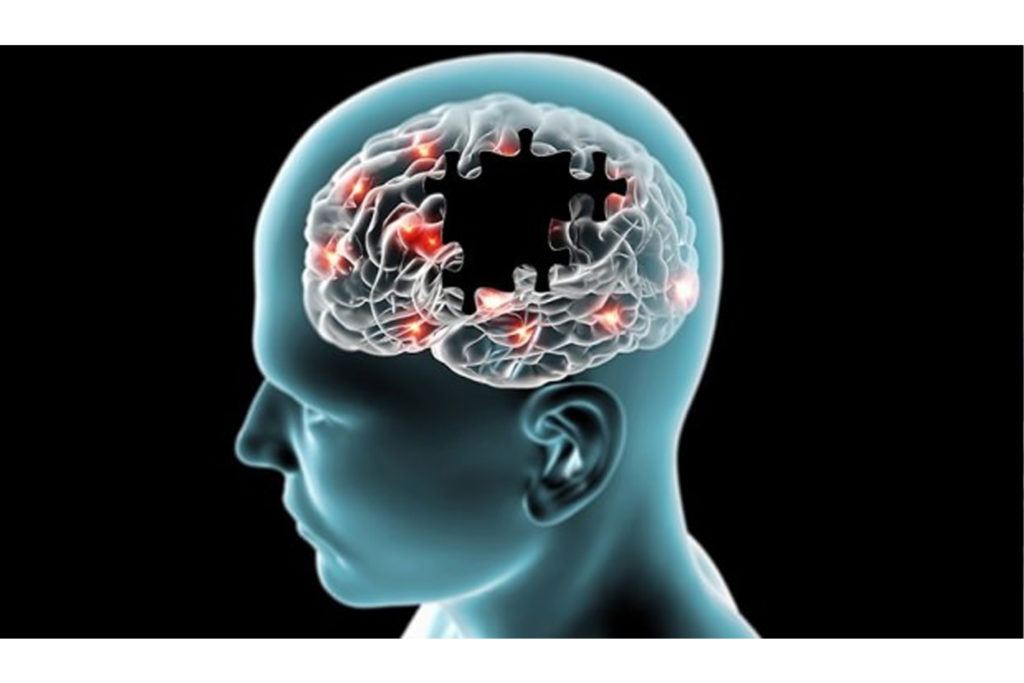 Alzheimer Hastalığı İlk Belirtilerden 20 Yıl Önce Başlıyor