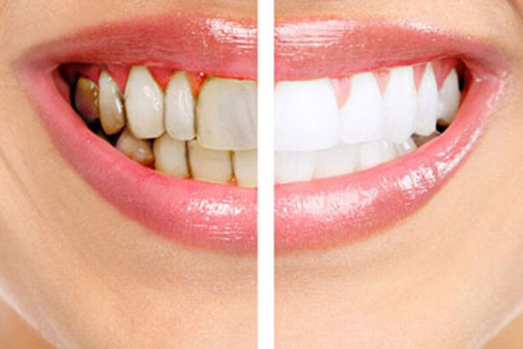 Ağız ve Diş Sağlığı Genel Vücut Sağlığımıza Açılan Kapıdır